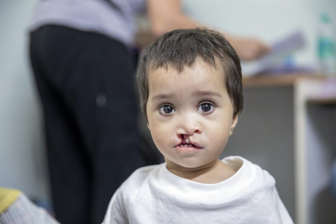 Meet 6-month-old Dilfa, before cleft surgery. Photo: Jasmin Shah.