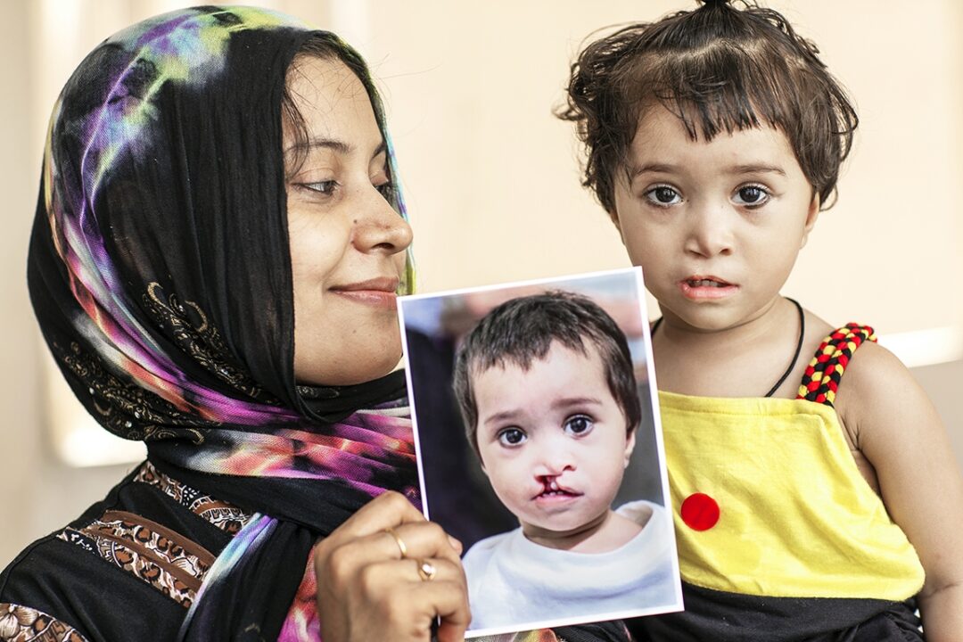 One year following her cleft lip surgery, 18-month-old Dilfa and her mom, Tasheen, pose for a photo to share her beautiful new smile. Photo: Jasmin Shah.