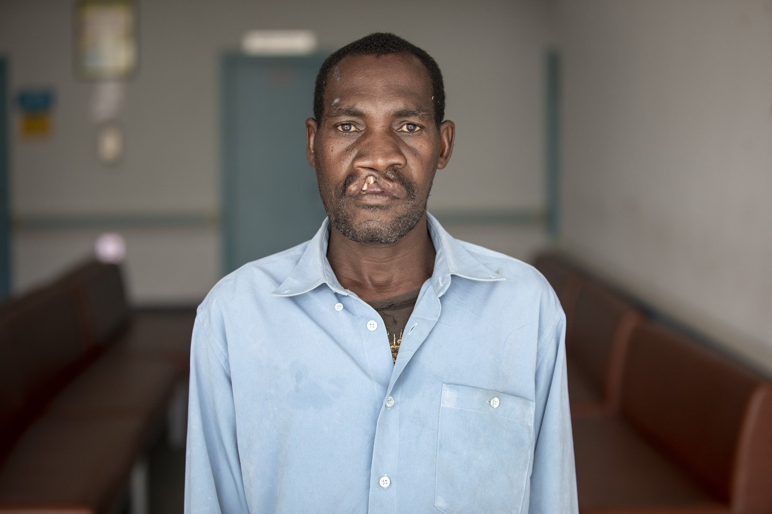 Cleft in adult Domingos. Photo: Zeke du Plessis.