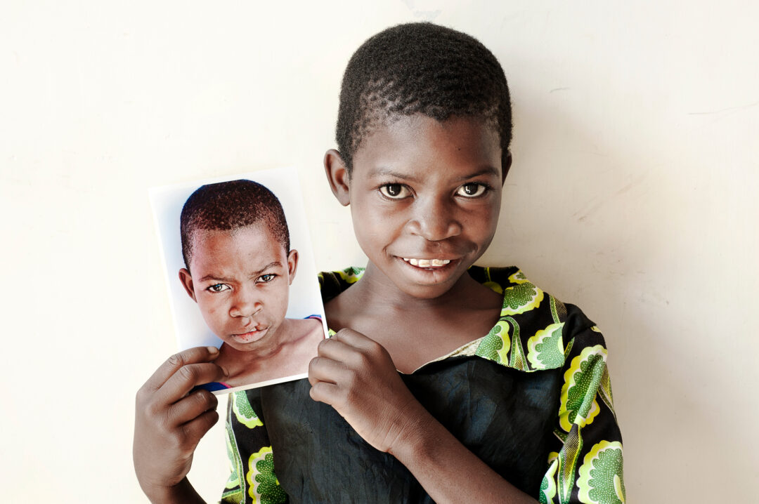 Mina holds a photo of herself before cleft surgery. Photo: Margherita Mirabella