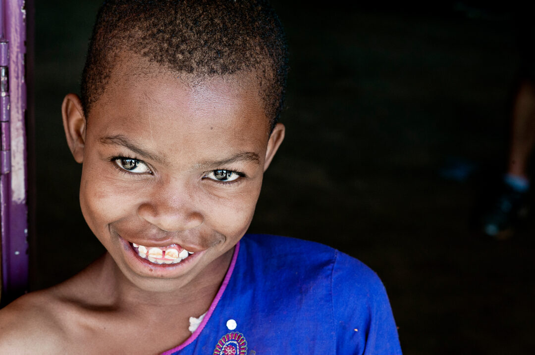 Mina smiles, before cleft surgery.