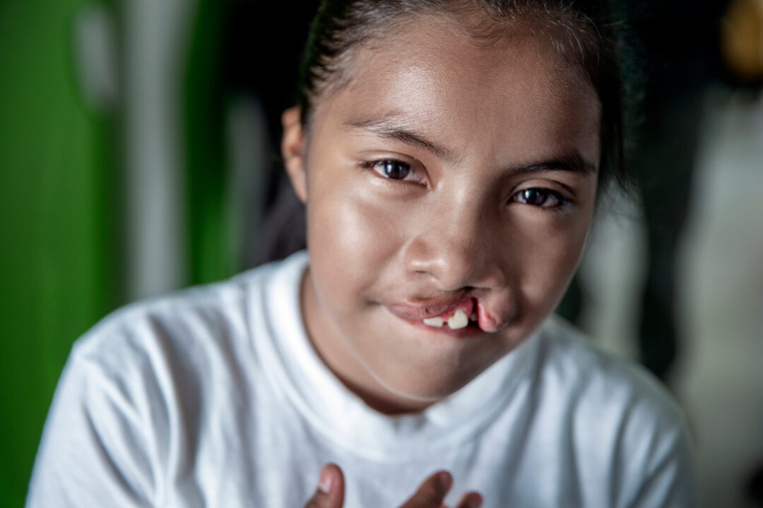 Child with cleft lip and cleft palate. Photo: Jorgen Hildebrandt