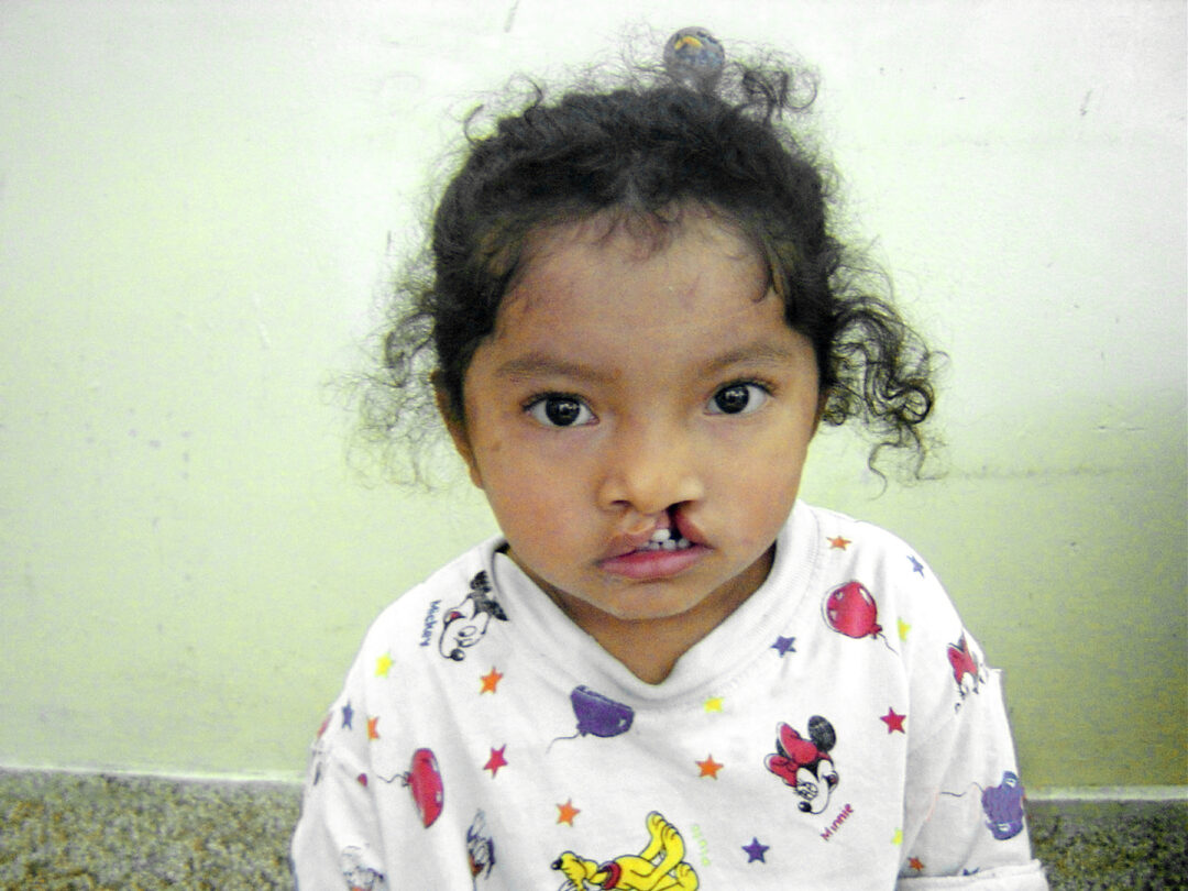 Priscilla, in 2004 before cleft surgery. Photo: Operation Smile