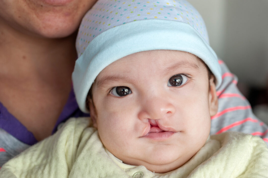 Four-month-old Arian before cleft surgery. Photo: Margherita Mirabella