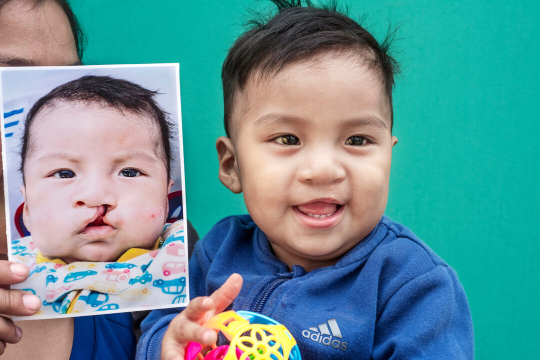 One-year-old Eduardo after cleft surgery. Photo: Margherita Mirabella