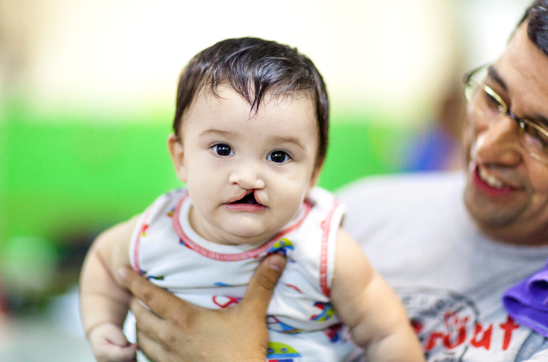 Seven-month-old Axel before cleft surgery