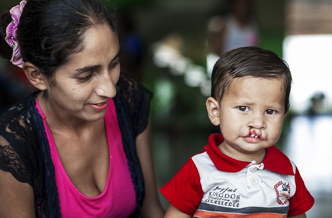 In 2016, 14-month-old Alex arrived with his mom, Ani, and his dad, Roberto, to an Operation Smile Paraguay surgical programme in Asunción. Photo: Carlos Rueda.