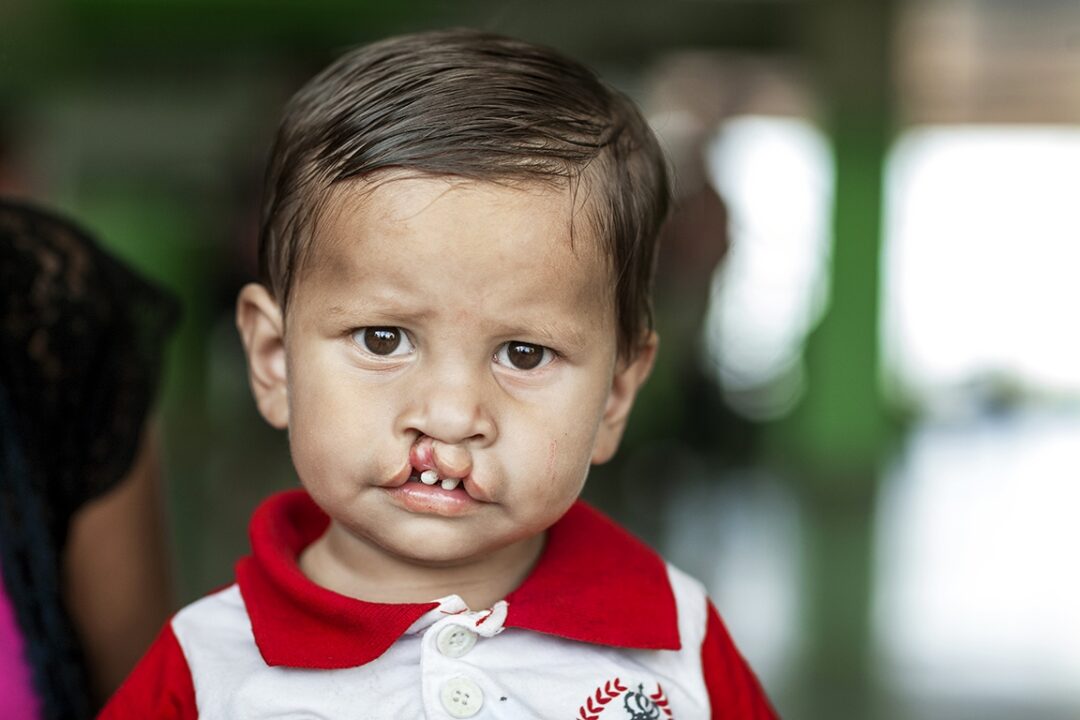 Boy with cleft lip and cleft palate