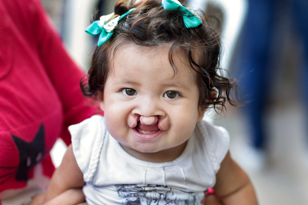 14-month-old Brenda, before cleft surgery