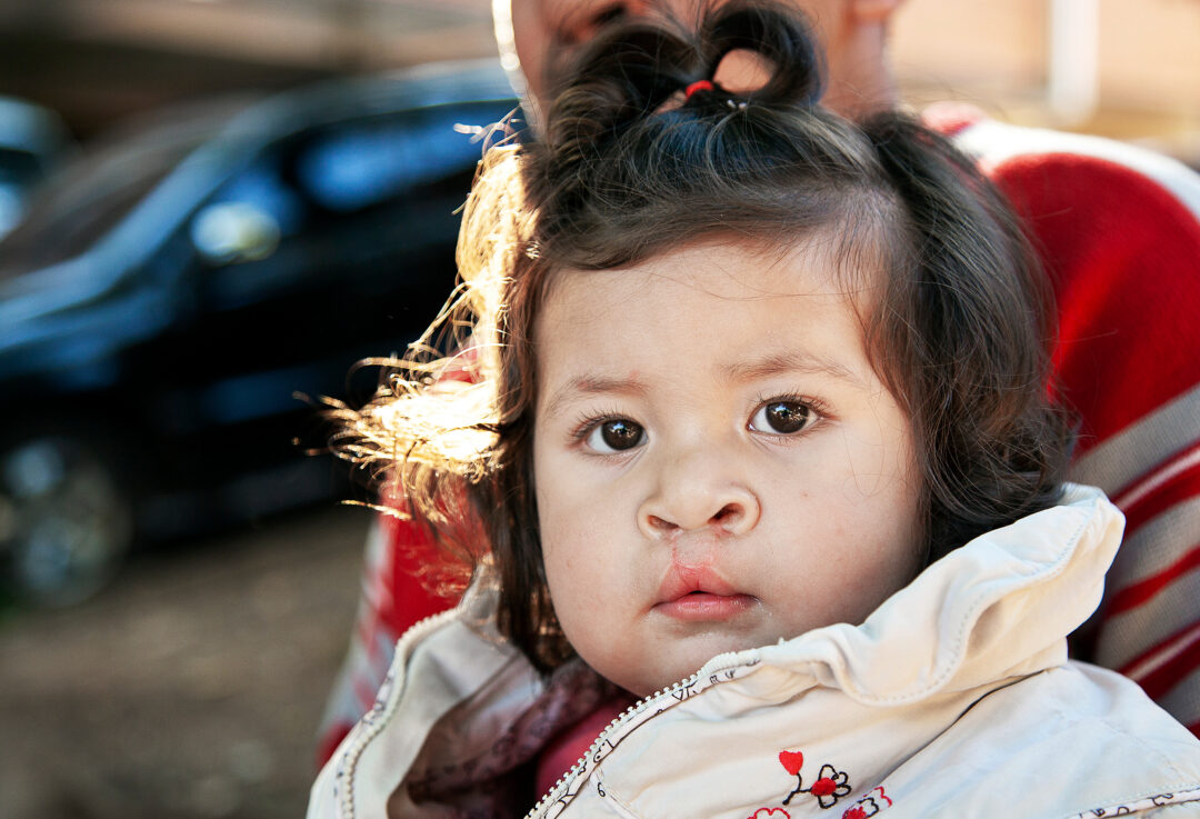 Brenda after cleft surgery. Photo: Paulo Fabre