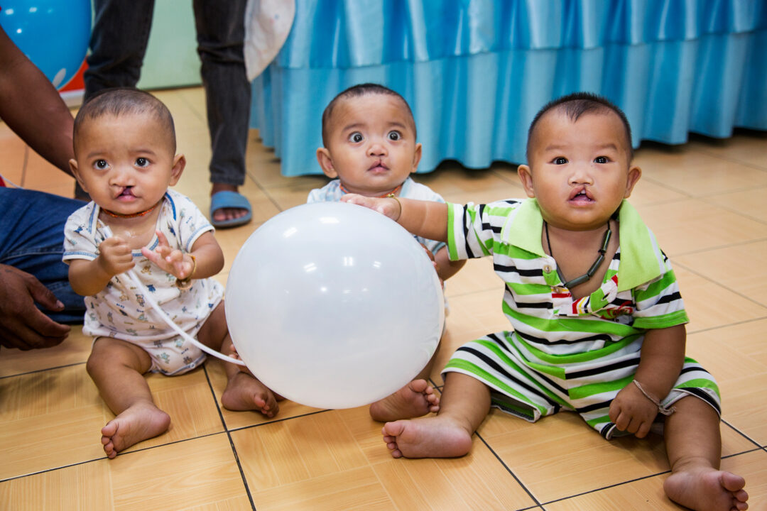 twin brothers with cleft. Photo: Peter Stuckings