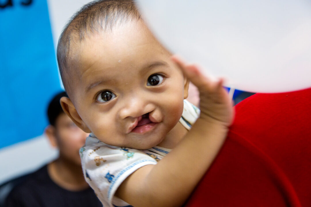 Eight-month-old Ou, before cleft surgery. Photo: Peter Stuckings