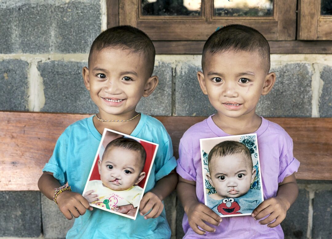 Twin brothers, both born with cleft lip and cleft palate, hold a photo of themselves before surgery