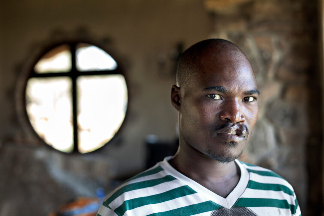 31-year-old Ephraim before cleft surgery. Photo: Zute Lightfoot
