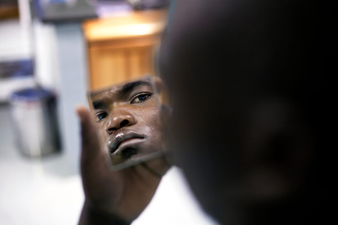Ephraim looks at himself for the first time after cleft surgery. Photo: Zute Lightfoot